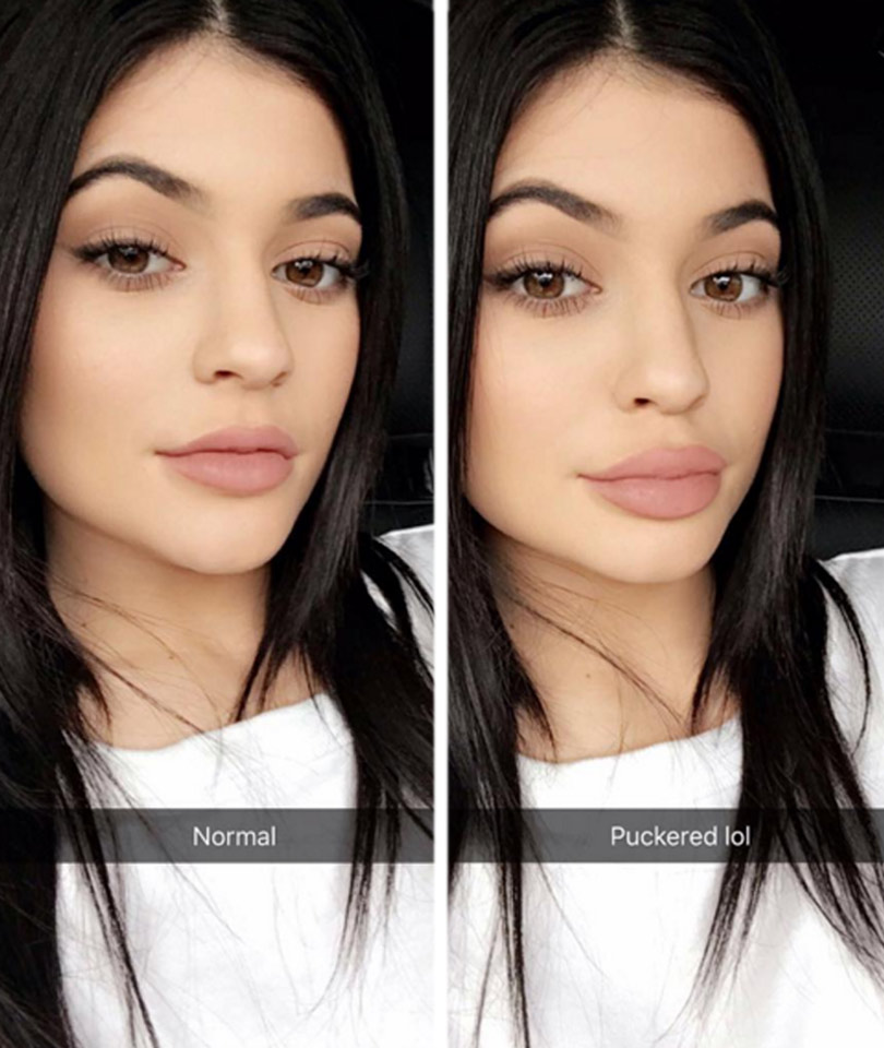 hyaluronic acid lip injections cost