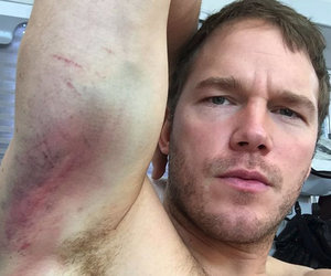 Chris Pratt Makes Even Nasty Bruises Look Really Hot (Photos)