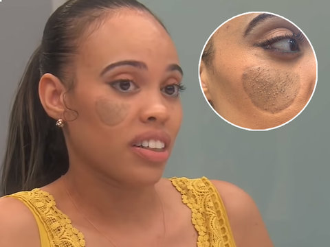 Dog Bite Victim With Pubic Hair Growing Out Of Face Wants Botched